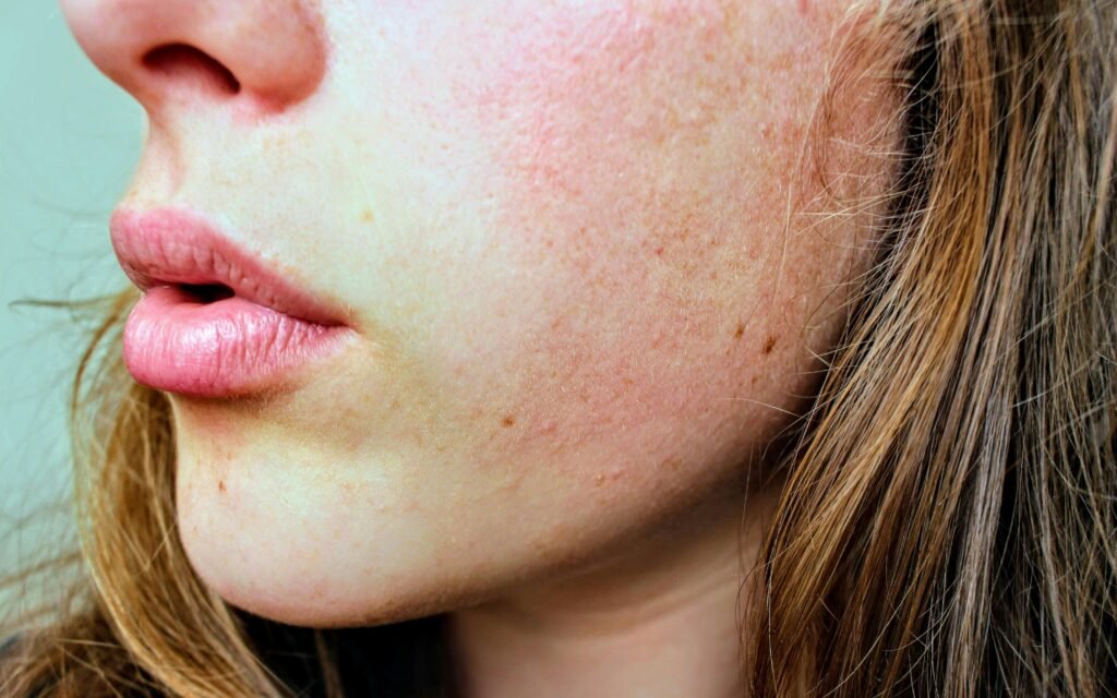 Skin Barrier